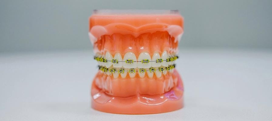 A model of a mount and teeth with fixed braces