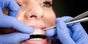 An orthodontist works on a patient's ceramic braces