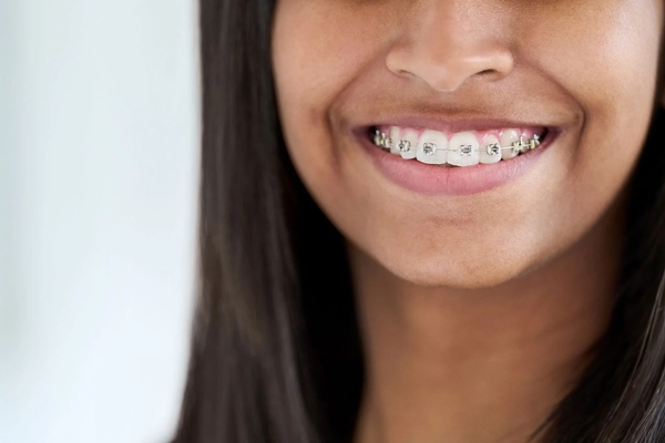 Fixed metal NHS braces on a smiling girl