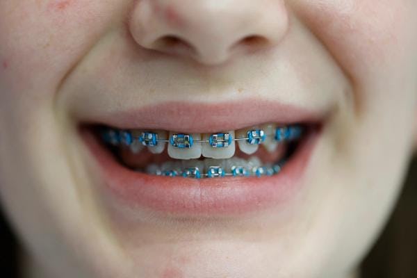 NHS braces in Ashington and Morpeth
