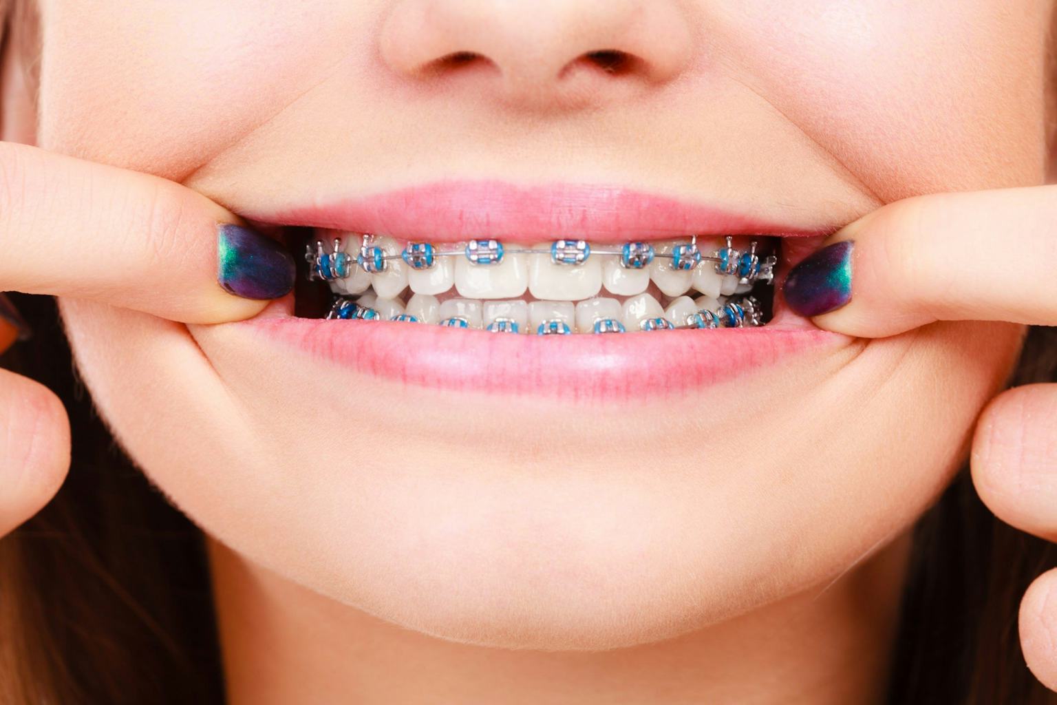 A patient reveals her colourful fixed braces