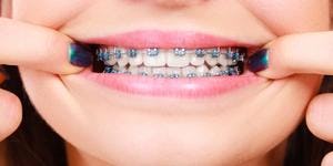 A close up on a teenager with fixed braces and a beautiful smile