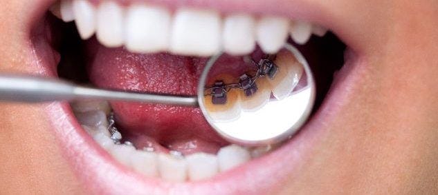 A lingual brace is viewed with a dental mirror