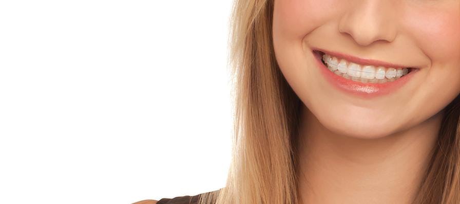 A young woman with ceramic braces smiles at the camera