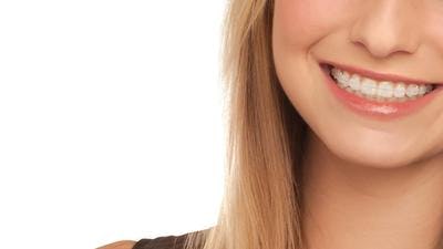 A young woman with ceramic braces smiles at the camera