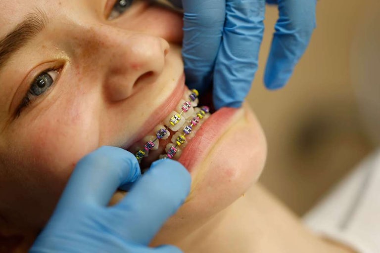 A young girl with her NHS braces with brightly coloured bracket modules