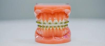 A model of a mount and teeth with fixed braces