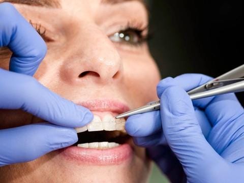 Ceramic Braces background