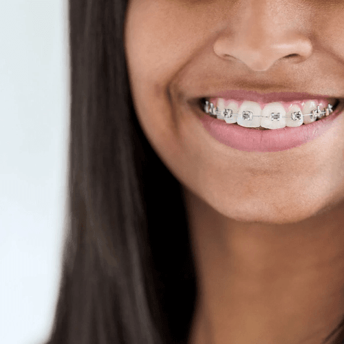 A wide smile with fixed metal braces