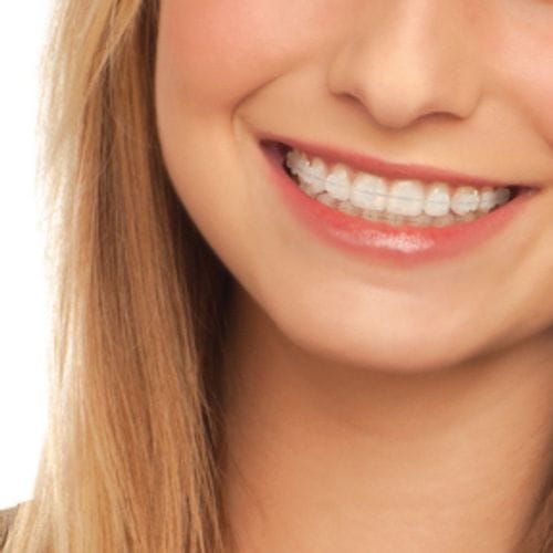 Tooth coloured ceramic brackets