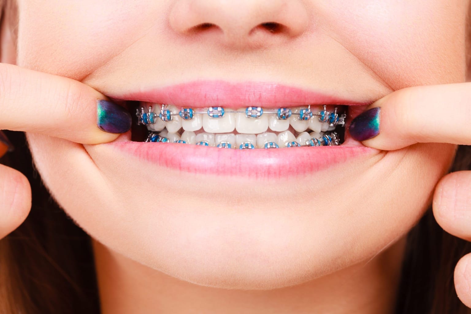 A patient reveals her colourful fixed braces