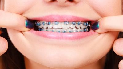 A close up on a teenager with fixed braces and a beautiful smile