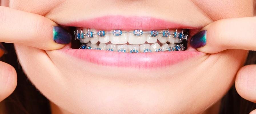 A close up on a teenager with fixed braces and a beautiful smile