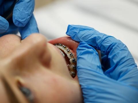 Fixed Metal Braces background