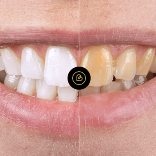 Tooth whitening - before and after