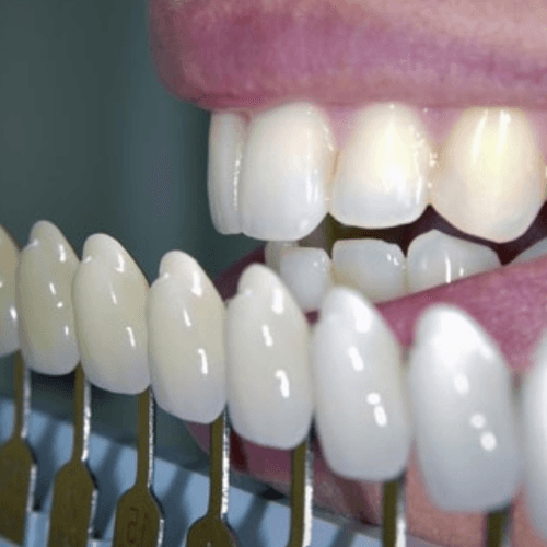Tooth whitening colour chart compared to a natural smile
