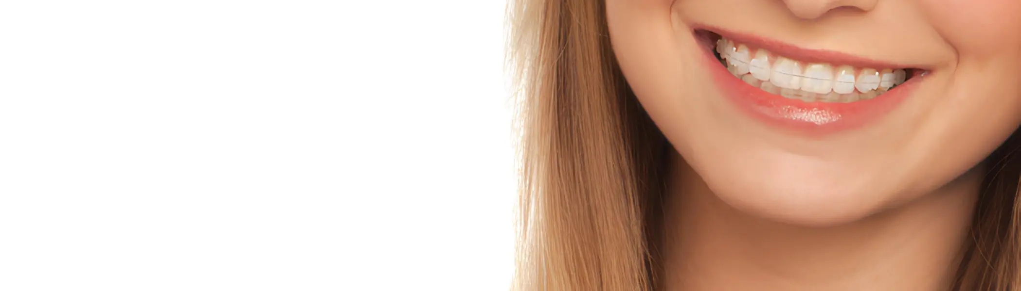 ceramic braces seen on a smiling woman, close up.