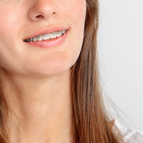 An adult with fixed metal braces, close up on lower face