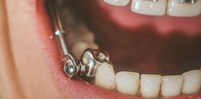 A Herbst appliance on a patient's lower right pre-molar