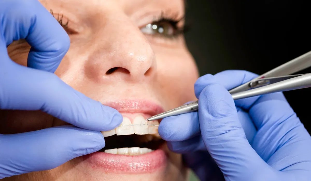 An orthodontist works on a patient's ceramic braces