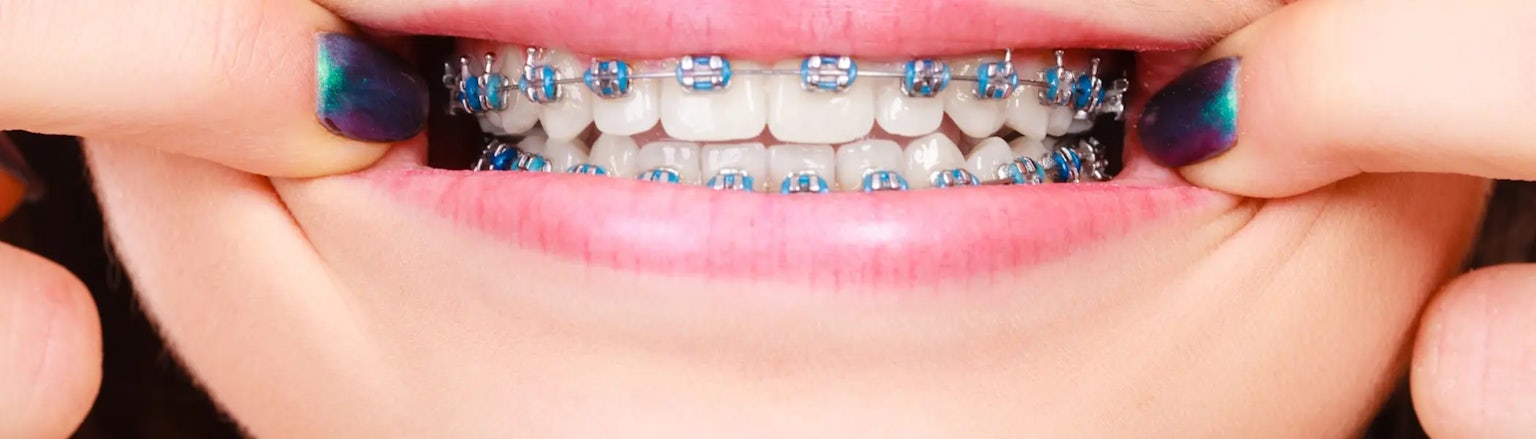 A young person pulls at the edge of their mouth to reveal fixed metal braces on their teeth.