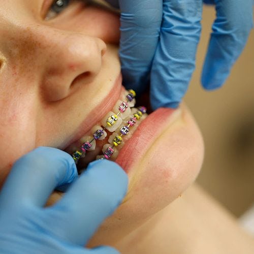 A close up of an orthodontist inspecting a fixed brace