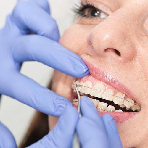 ceramic braces are cleaned by a dentist
